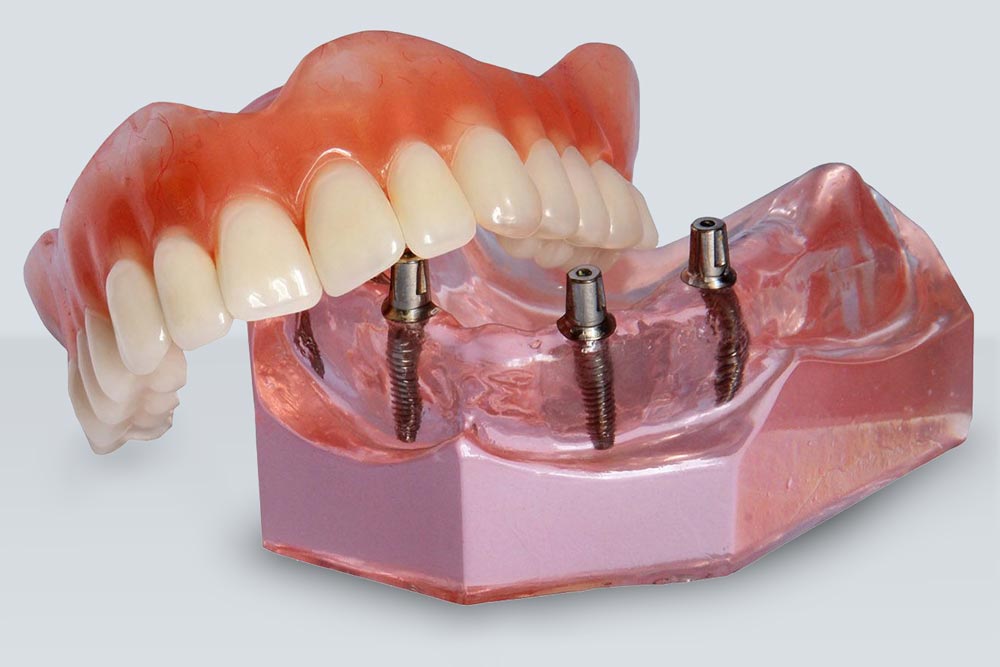 Implant-supported dentures